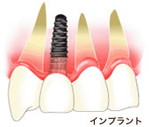 インプラント