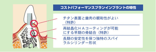 コストパフォーマンスインプラントの特性